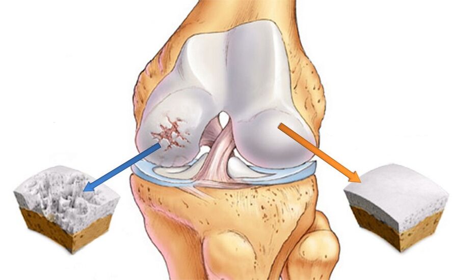 Osteoarthritis of the knee joint and healthy cartilage