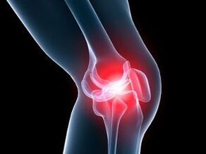 Osteoarthritis of the knee joint, which causes knee pain