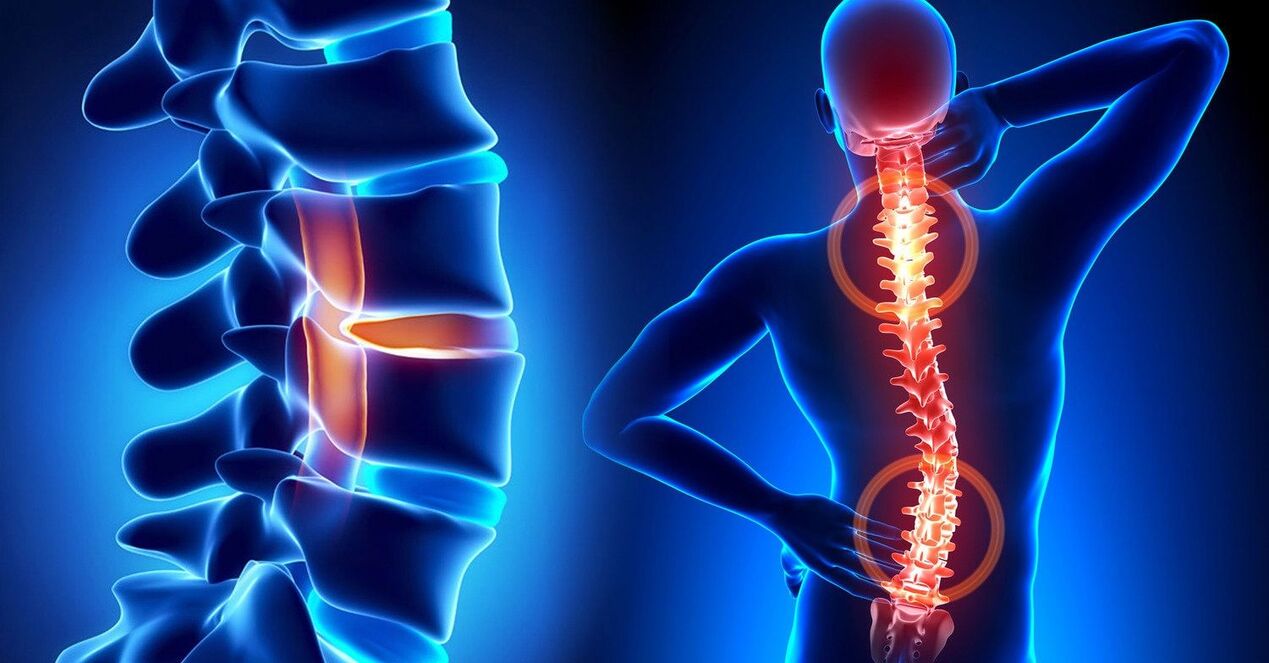 A diseased spine leads to neck problems