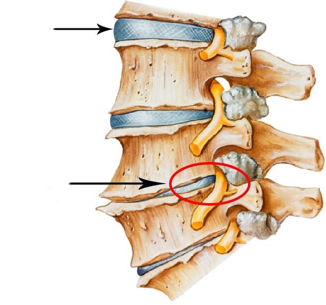 Development of hard disk hernia