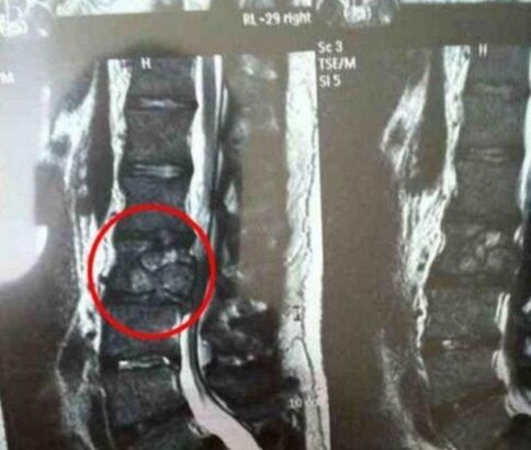 The vertebral sala tumor in the picture