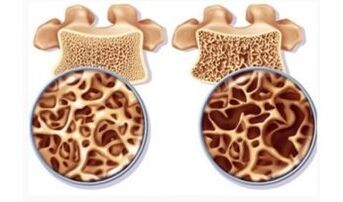 Danger of the cervical eye eye for women