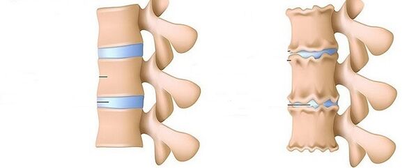 Healthy spine and osteochondrosis