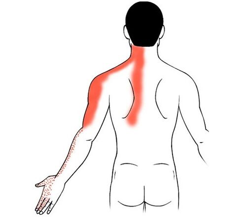 cervical osteochondrosis as a cause of pain in the finger joints