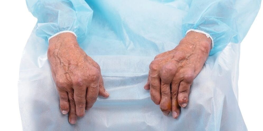 Infectious arthritis is a disease with constant pain and changes in the finger joints.