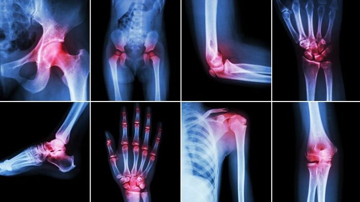 Joints of the body affected by osteoarthritis