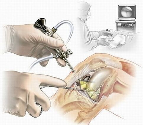 Knee arthroscopy for osteoarthritis